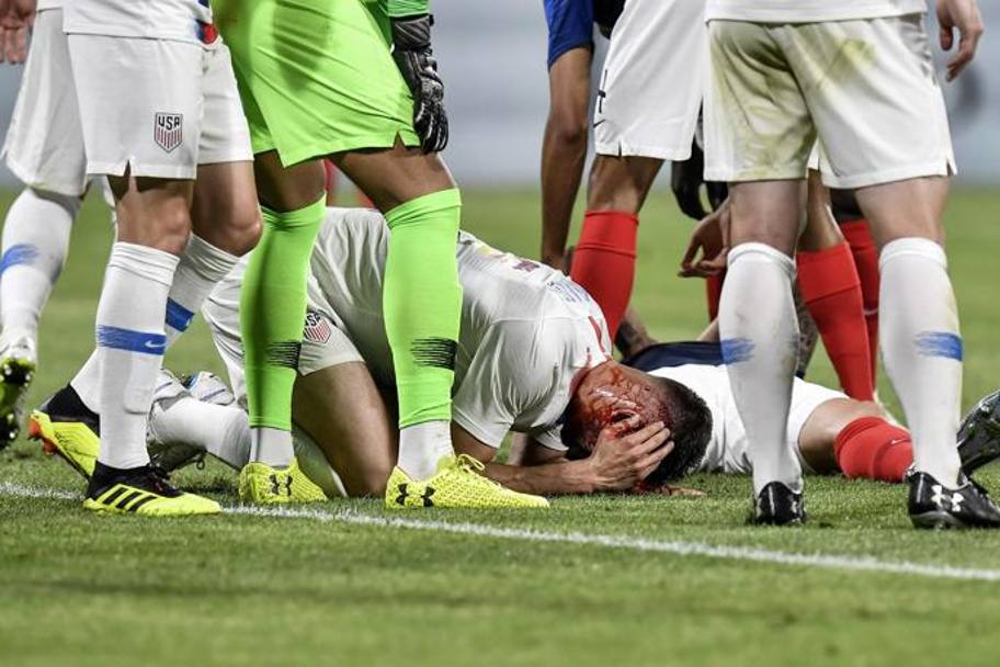Il sangue di Miazga dopo lo scontro con Giroud. Afp